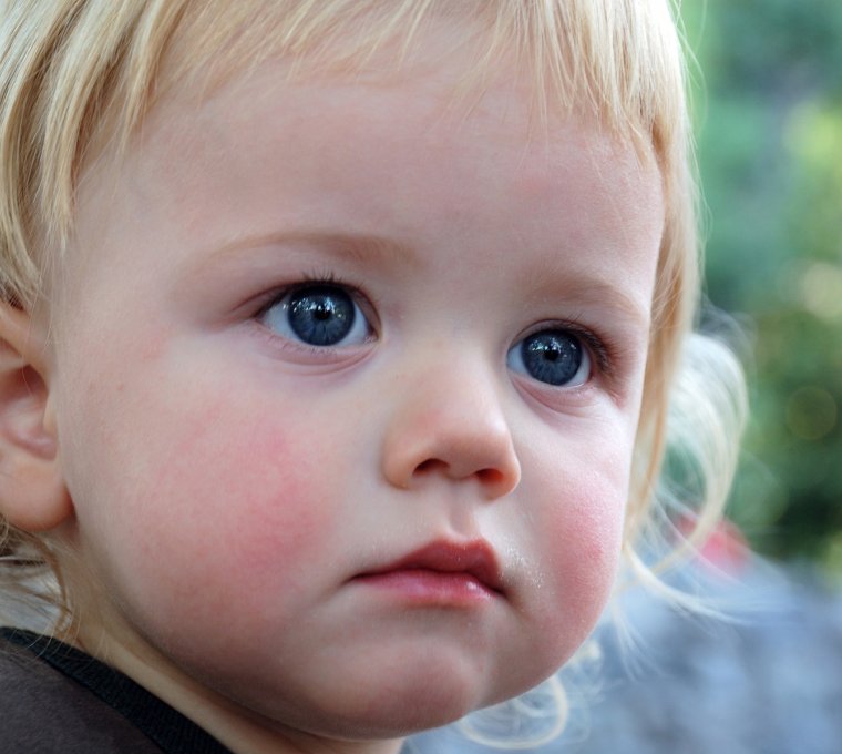 Pękające naczynka u dzieci